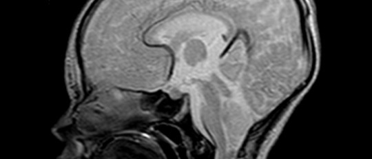 Malformación de Arnold Chiari