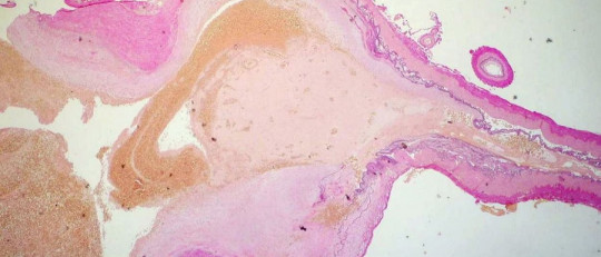 Los tipos de aneurisma