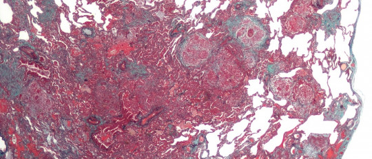 Los tipos de hipersensibilidad