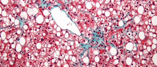 Esteatosis hepática (hígado graso): causas, síntomas y tipos