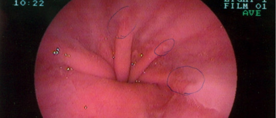 Hernia de hiato: tipos, síntomas, causas y tratamiento