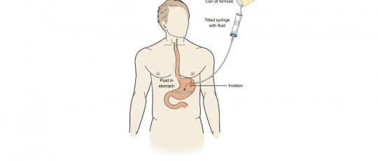Nutrición enteral: tipos, definición y usos con pacientes