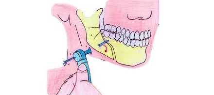 Tornillos bicorticales