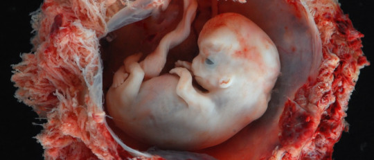 Síndrome o secuencia de Potter: tipos, síntomas y causas