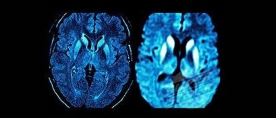 Enfermedad de Creutzfeldt-Jakob (ECJ): causas, síntomas, diagnóstico y tratamiento