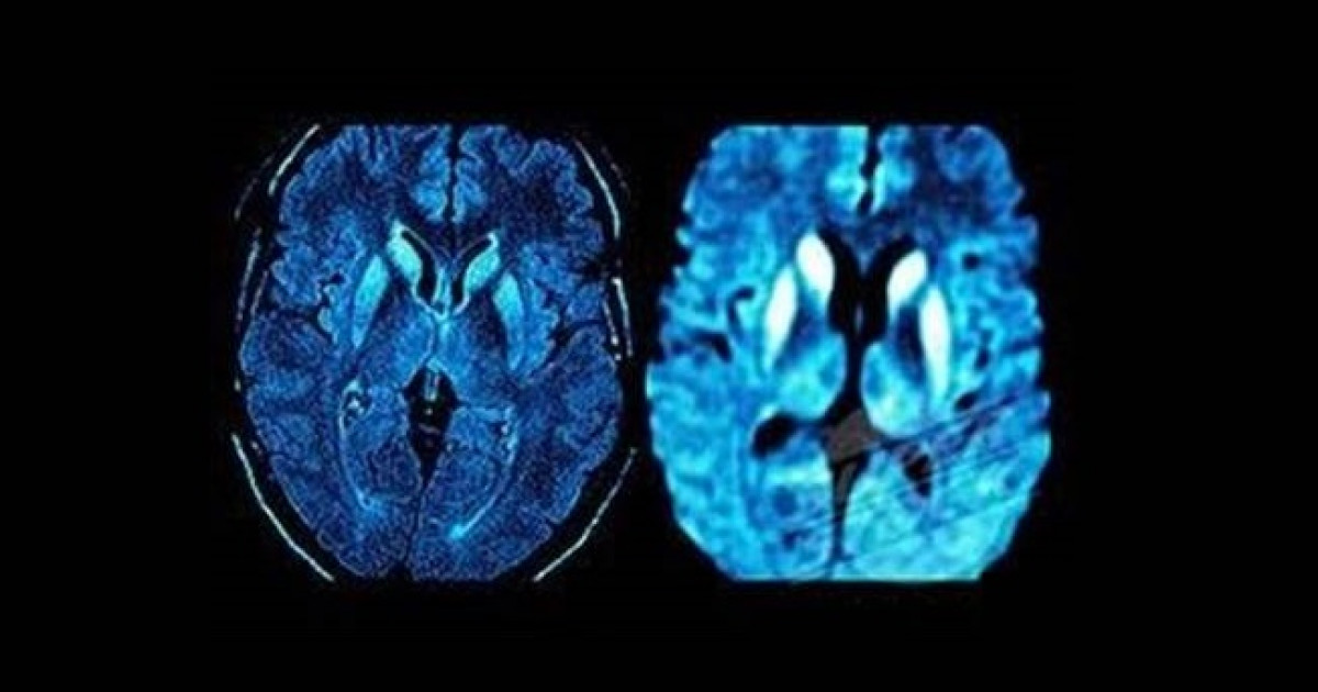 Enfermedad de CreutzfeldtJakob (ECJ) causas y síntomas