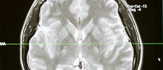 Bases neurológicas de la lectura