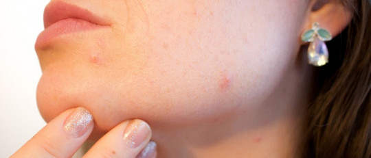 Tipos de acné
