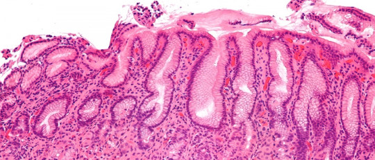 Diferencias entre gastritis y gastroenteritis