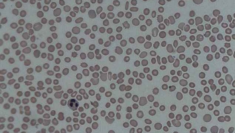 Trombocitopenia en la sangre